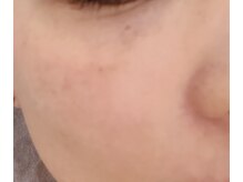 アグライア(Aglaea)/シミケア／before／目元