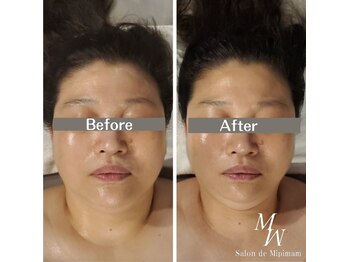 ミピマムマール(Mipimam Maaru)/お客様before→after