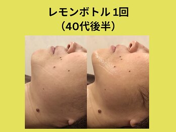 アユアラングレース/レモンボトル1回