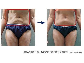 サクランボ(SAKURAMBO)/NONFシェイプEXで引き締め強化☆