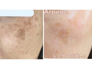アルページュ(Arpege)/スポット集中シミケア＆水滴LDM
