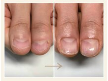 キュアネイル(Qa Nail)/ハンド【深爪矯正】