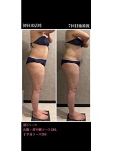 トータルビューティー ミミ(Total Beauty mimi)/週3ペースで太ももスッキリ！！