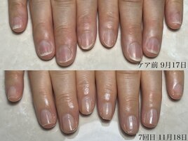 自爪育成3ヶ月コース