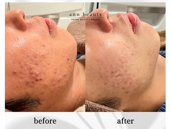 アン ビューティー(ann beauty)/施術3回【症例写真】10代男性