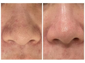 ローゼ(ROSE)/【WiQO水光ピーリング】