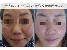 ラグランシエル(Le grand ciel)/全体的なリフトアップ