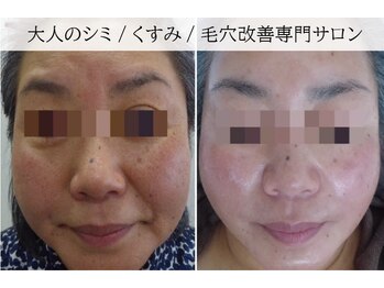 ラグランシエル(Le grand ciel)/全体的なリフトアップ