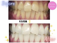 エクシアホワイトニング 天王寺店/ホワイトニングビフォーアフター