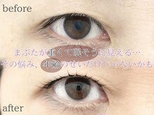 アイラッシュサロン ウインクル(Eyelash Salon Winkle)/まぶたが重く見える悩み