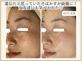 ポモナ 横浜馬車道店(Pomona)/こまかいシミに長年お悩み