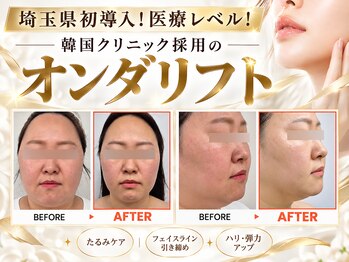 ジェムスキンラボ 所沢店(GEM SKIN LAB)の写真/《埼玉唯一の韓国製オンダ導入店★》若い頃と違うもたつき・二重アゴに！とにかく小顔になりたい方向け！