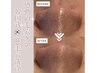 TikTok・SNSで話題お鼻の黒ずみ解消♪韓国式3D毛穴洗浄90分 ¥12,800→ ¥7,700