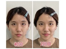 小顔22 ボルティ 本店(Bolty)/before→after（2回目）