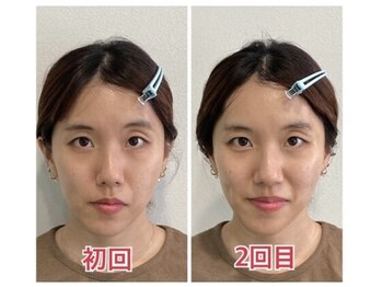 小顔22 ボルティ 本店(Bolty)/before→after(2回目)