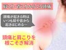 【首肩こりからくる頭痛に】首肩こりにも◎頭痛整体＆鍼　¥3,980