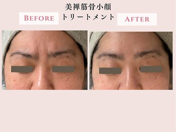 レクラ バイ ドクターエイチ(L'ECLAT by Doctor.H)/美禅筋骨小顔トリートメント