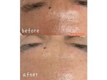 センガン(SENGAN)/毛穴洗浄はお肌のトーンUP効果も