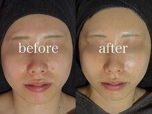 ルテア(Retea.)/REVIハーブピーリング