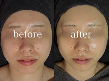 ルテア(Retea.)/REVIハーブピーリング