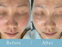 イーヴ(Eave)/毛穴洗浄/濃密パック/ピーリング