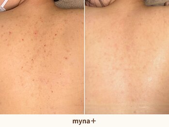 マイナプラ 表参道(myna+)の写真/夏目前！前撮り・挙式当日に向けた“ドレス映えする背中”へ【剥離なしハーブピーリング】背中上部 ¥14800-