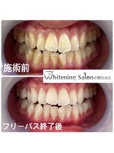ホワイトニングサロン 京都烏丸店/ホワイトニング施術例