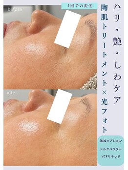 クレヴィー(Creviy)/陶肌トリートメント×光フォト