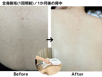 エミエット(Emiette)/全身脱毛　　
