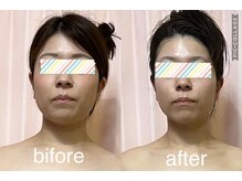 アコラージュ/レモンボトル/小顔/ブライダル