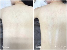 ラウレア(LAULEA)/ハーブピーリングBefore/after