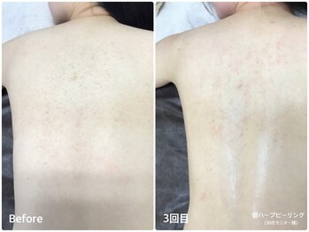ラウレア(LAULEA)/ハーブピーリングBefore/after