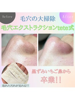 エミュ(emu)/毛穴エクストラクション
