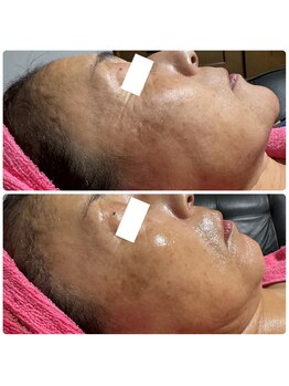 エステサロンブランシュ(Esthe salon Blanche)/ハーブピーリングでエイジング