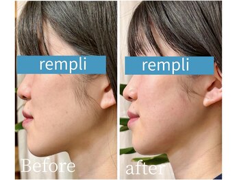 ランプリール 学芸大学(rempli)/フェイシャル1回 Before/after