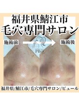 ピュール 鯖江店(PUR)/毛穴/毛穴ケア/毛穴洗浄