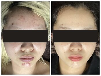 肌レボ 池袋店(肌REVO)/ハーブピーリング5ヵ月の変化