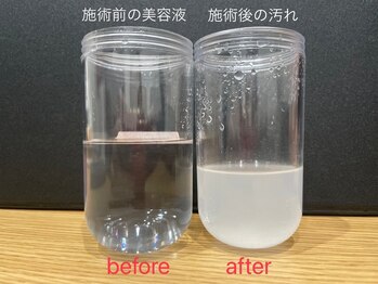 トリアングル(TLIENGLE)の写真/【高宮】吸い取った毛穴の汚れが目に見えるから満足度◎話題の《毛穴洗浄フェイシャル》で本気の毛穴ケア♪