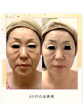 カブール 町田/たるみケアにはバイオセル！