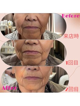 リラクゼーションサロン ラキ(laki)/ネオピール/ピーリング