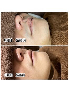 リット 広島並木通り(Lit)/髭脱毛