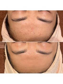 トータルエステティック ジョワイユ(JOYEUX)/トラブル肌→さらツヤ肌質改善