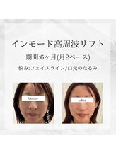 メディカルエステ 東銀座店/業界初インモード高周波リフト