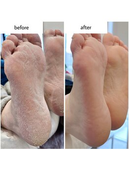 ケアプラス(care plus)/足裏角質ケア