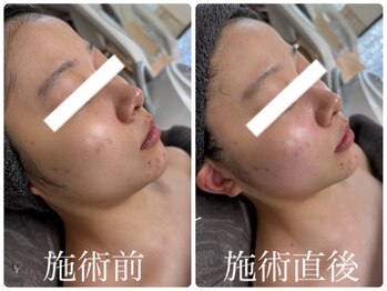 シェミー(CHEZ MEE)/小顔/フェイスライン/食いしばり