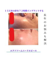 サロン叶(kanau)/エクソソームハーブピーリング