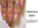 施術後6週間のお客様