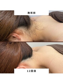 ミース 北九州店/うなじ★ビフォーアフター