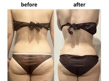 ダリアビューティー(Dahlia Beauty)/キャビテーション女性 全身5回