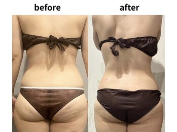 ダリアビューティー(Dahlia Beauty)/キャビテーション女性 全身5回